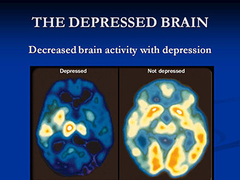 Depression-Its Symptoms Causes And Treatment