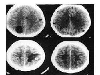 Seizures In Children