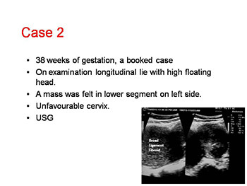 Role of Cesarean Myomectomy In Contemporary Practice