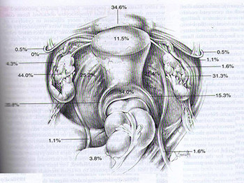 Endometriosis