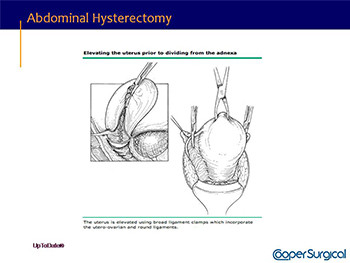 Hysterectomy