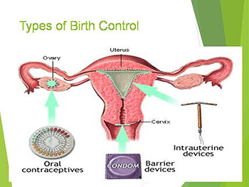 Contraceptive Methods