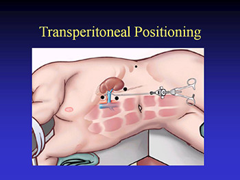 Basic Principles of Laparoscopy