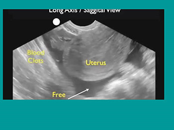 Miscarriage And Ectopic Pregnancy