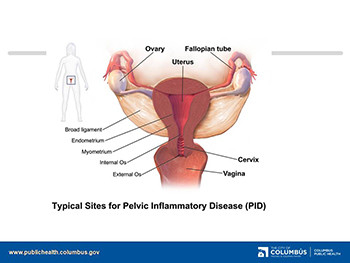 Pelvic Inflammatory Disease