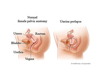Utero-Vaginal Prolapse