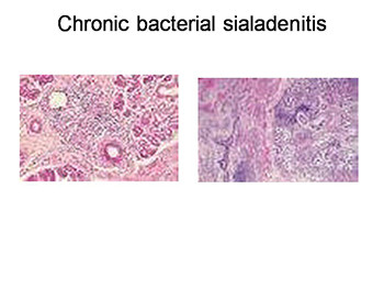 About Salivary Gland Diseases