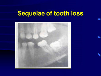 Introduction To Prosthodontics