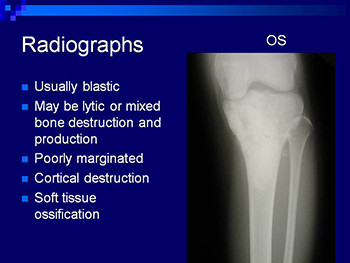 Bone And Soft Tissue Sarcomas