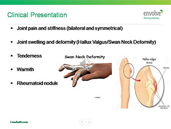 Rheumatoid Arthritis-RA-Management