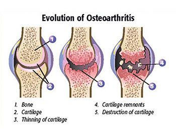 Osteoarthritis