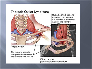 Thoracic Outlet Syndrome