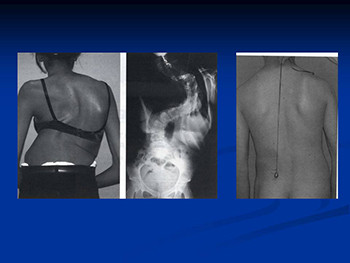 Approach To A Case of Scoliosis
