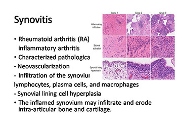 Arthritis-Approach To Diagnosis