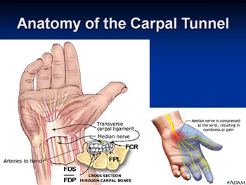 Carpal Tunnel Syndrome