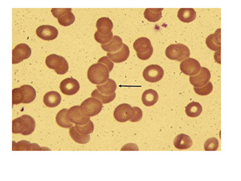 Erythrocyte Sedimentation Rate-ESR