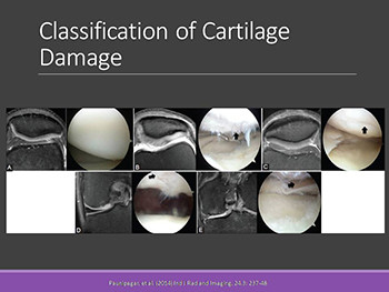 Cartilage Injury and Surgical Treatment