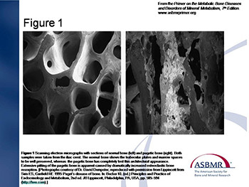 Pagets Disease of Bone