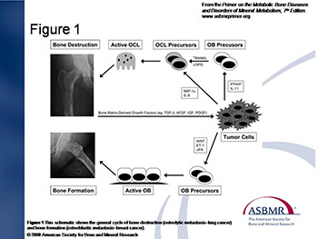 Orthopedic Treatment of Metastatic Bone Disease