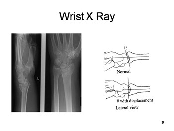 Common Fractures