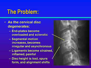 Neck and Arm Pain