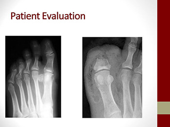 Diabetic Foot