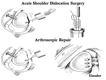 Acute Anterior Dislocation of The Shoulder
