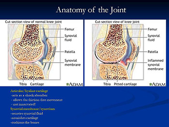 Rheumatoid Arthritis