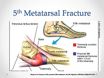 Foot and Ankle Injuries