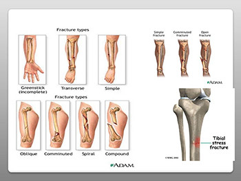Fractures-Types Complications and Management