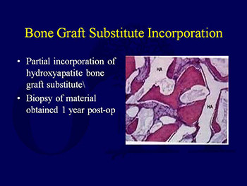 Bone Grafting and Bone Graft Substitutes