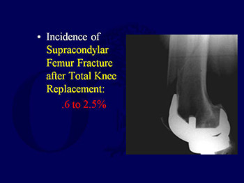 Treatment of Peri-Implant Fractures of The Femur