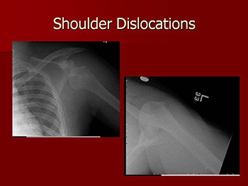 Upper Extremity Trauma