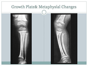 Metabolic Bone Disorders