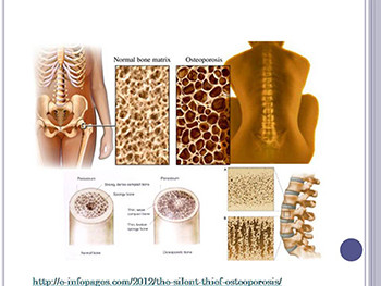 About Osteoporosis