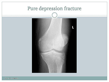 Plateau Tibial Fracture