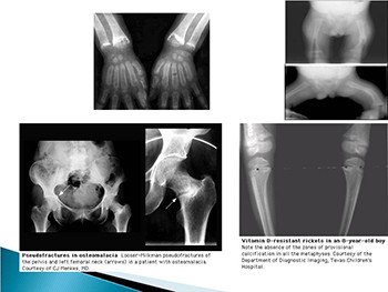 Rickets and Metabolic Bone Diseases