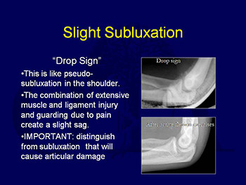 Traumatic Elbow Instability