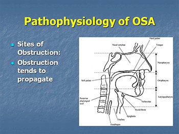 Surgical Management of Obstructive Sleep Apnea