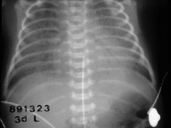 Respiratory Distress in Newborn