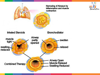 Pediatric Asthma