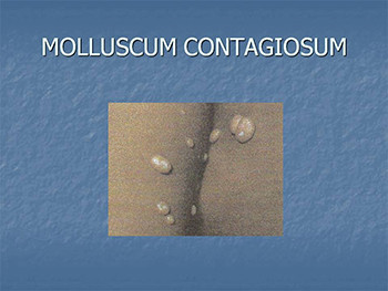 Common Childhood Infections and Rashes