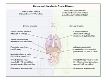 Cystic Fibrosis