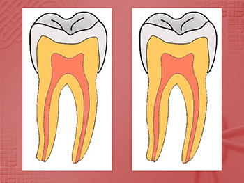 Dental Caries