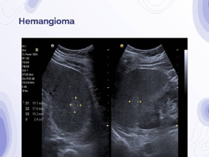 Spleen Ultrasound