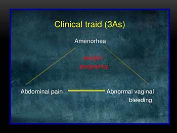 Ectopic Pregnancy