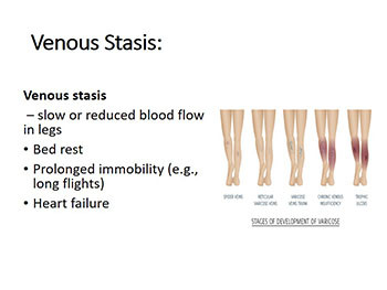 Venous Thrombosis