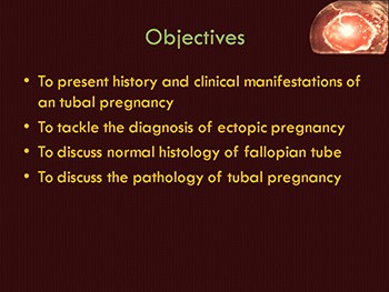 Ectopic Pregnancy