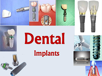 Dental Implants