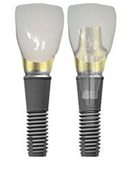 Лучшие импланты в москве. Вахтанги х москва имплантолог. Лучшие импланты в москве. Лучшие импланты в москве. Лучшие импланты в москве.